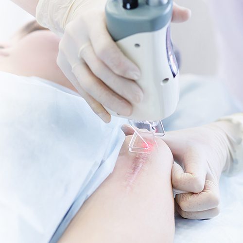 Scar Revision