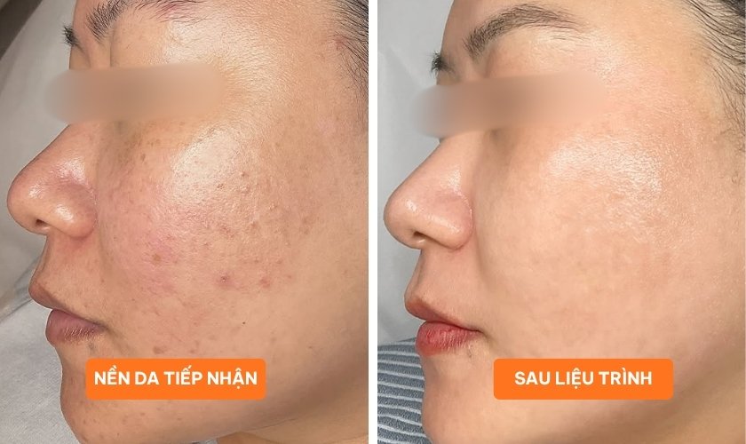 Laser Fotona Dynamis NX Line tái tạo da
