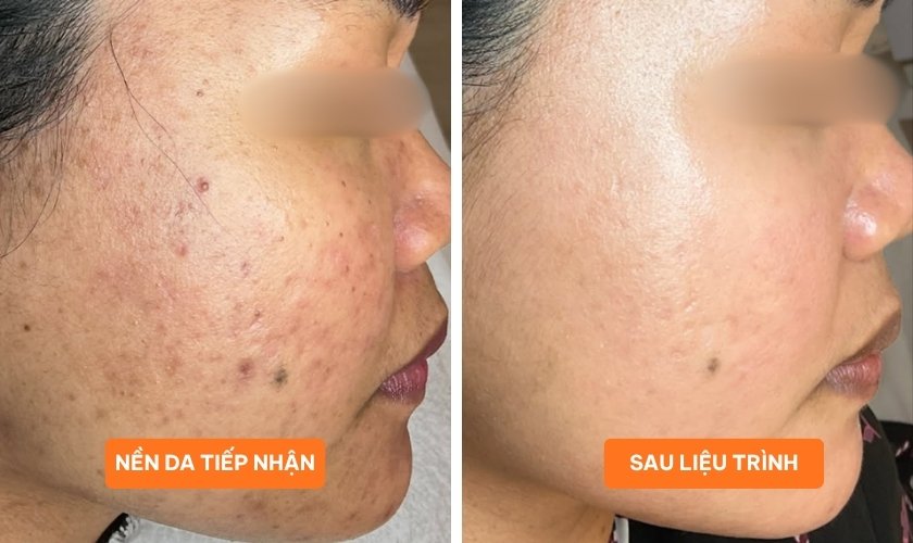Laser Fotona Dynamis NX Line phù hợp với mọi loại da