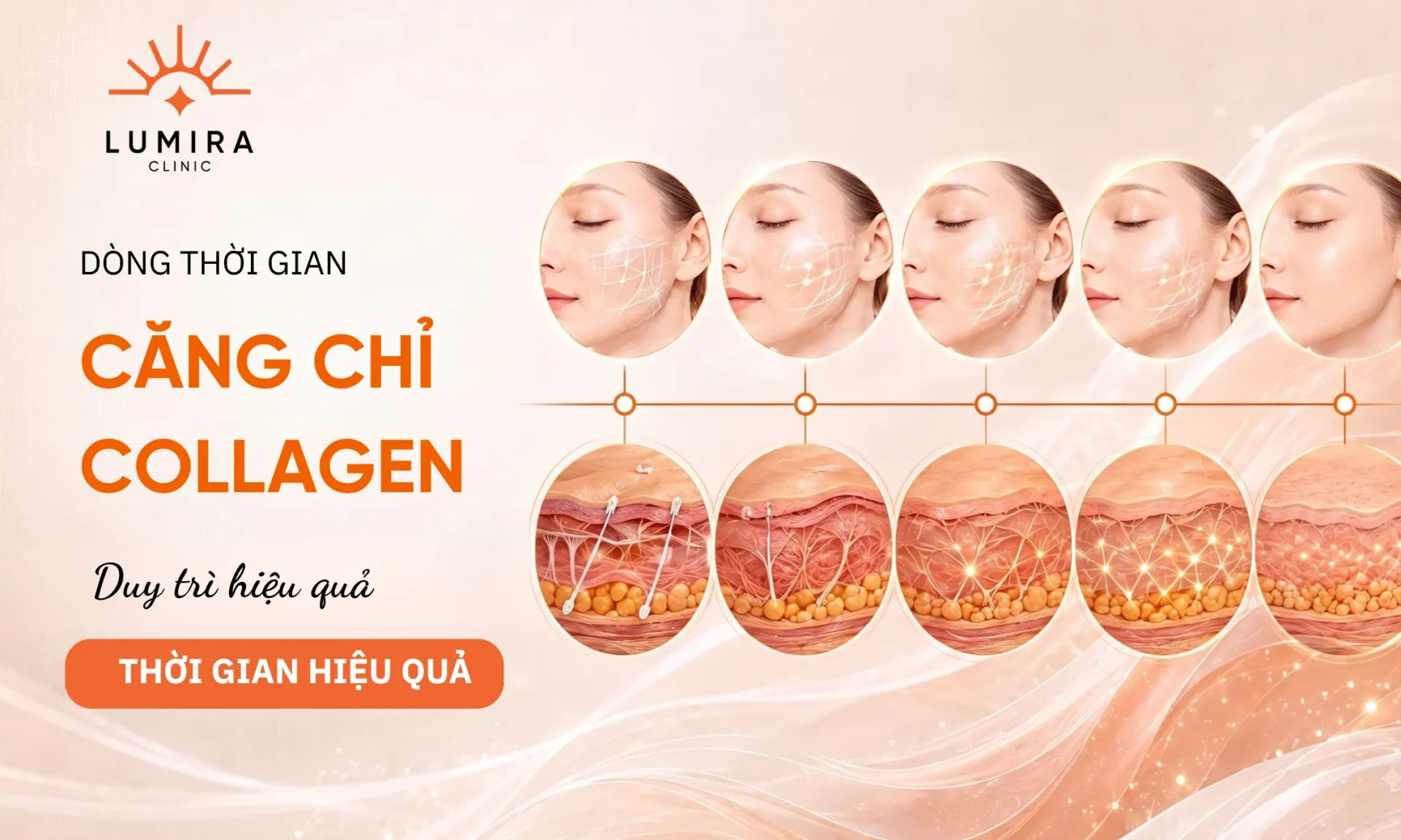 Căng Chỉ Collagen Toàn Mặt Giữ Được Bao Lâu?