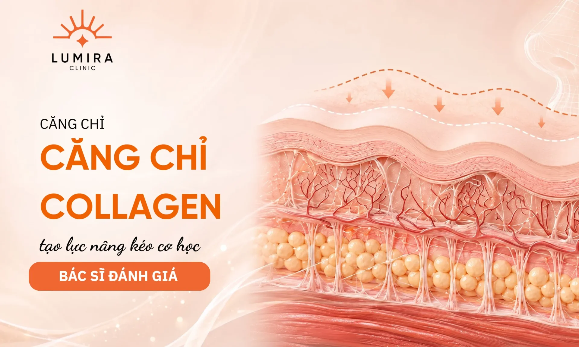Chỉ định y khoa: Ai là đối tượng thích hợp cho căng chỉ?