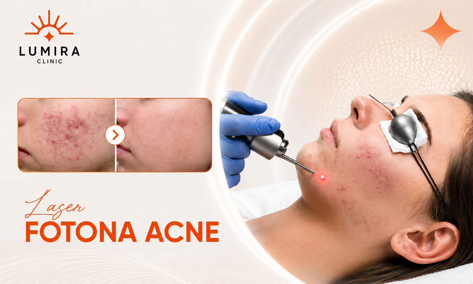 Fotona Acne Hỗ Trợ Kiểm Soát Mụn Cá Nhân Hóa