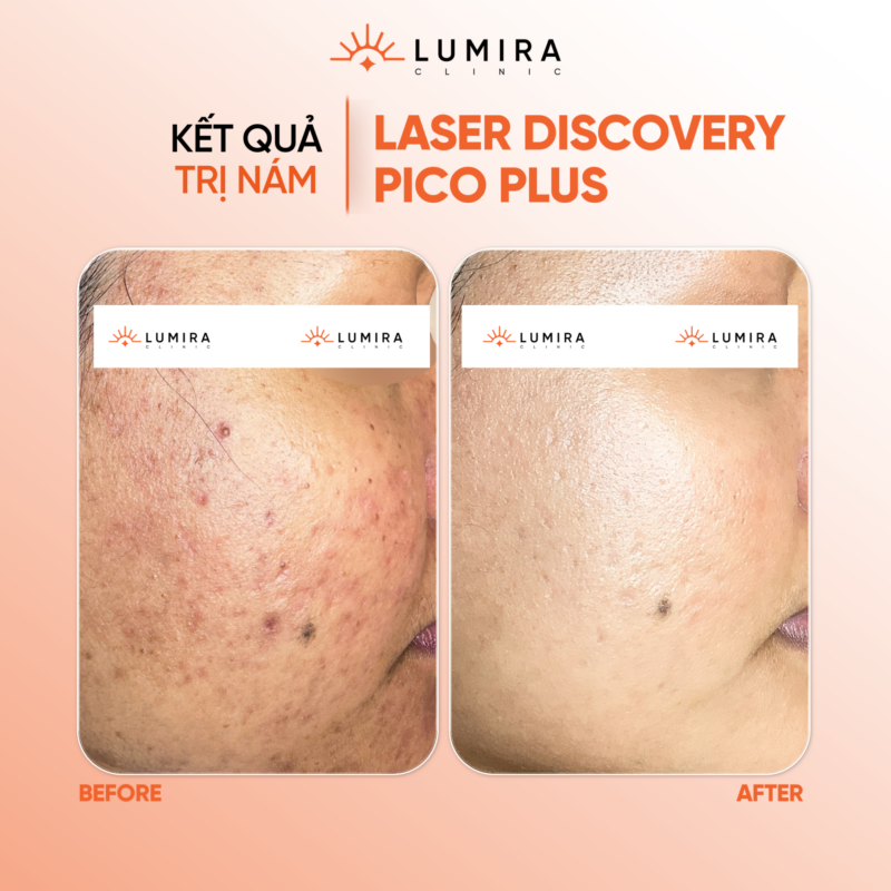 Trị Nám Với Laser Pico Discovery Plus