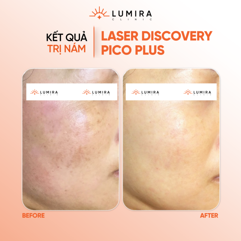 Điều Trị Nám Nội Tiết & Laser Xóa Xăm