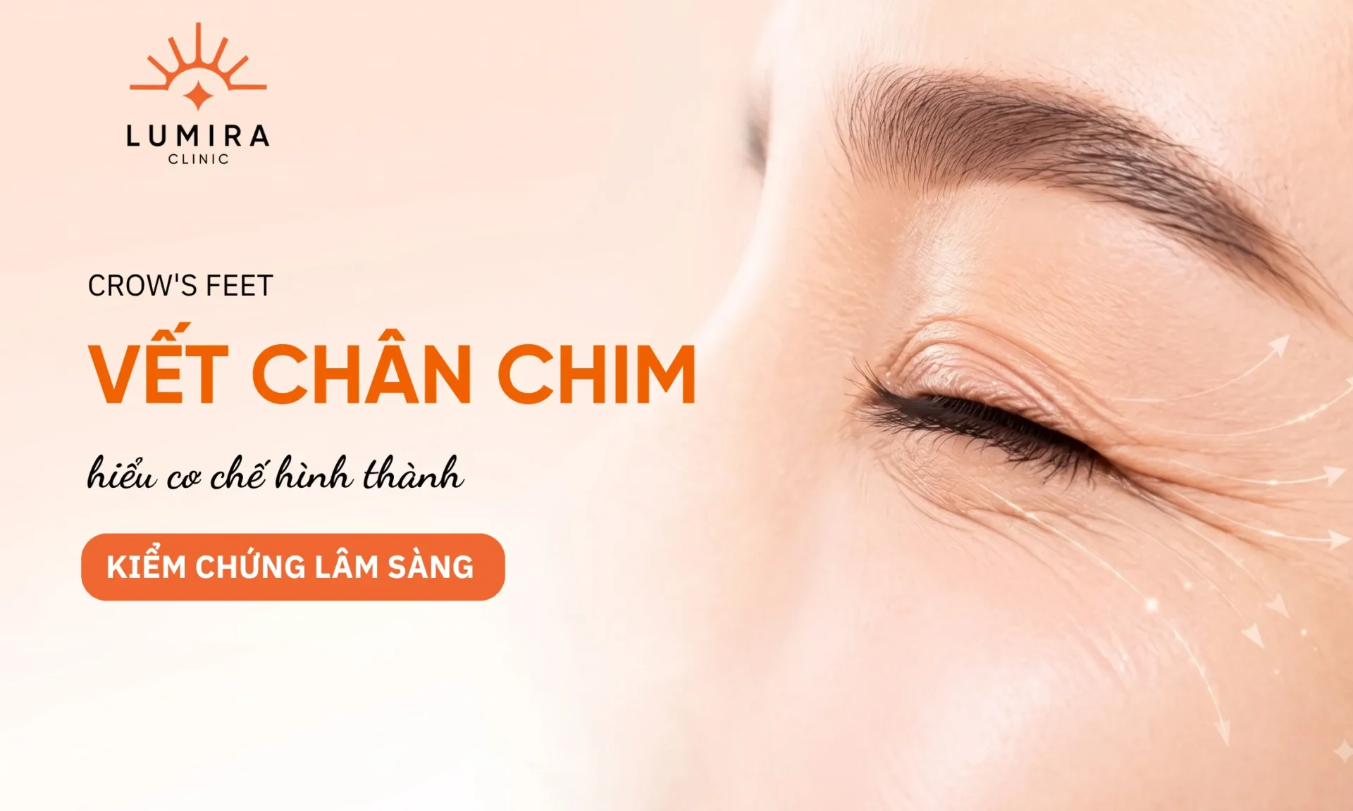 Nếp Nhăn Ở Mắt Khi Cười: Nếp Nhăn Động Và Vết Chân Chim