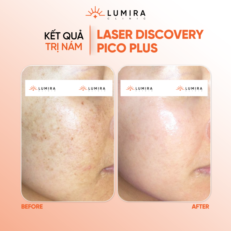 Phục Hồi Da Nhạy Cảm & Da Sau Laser