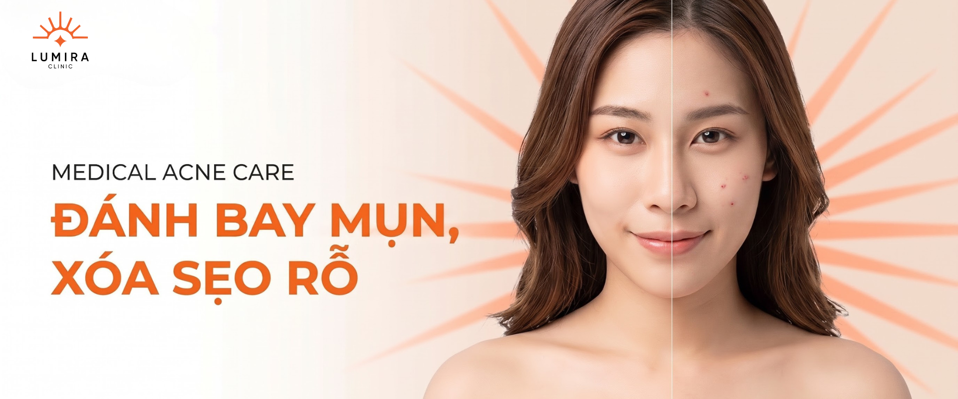 TRỊ MỤN & SẸO RỔ