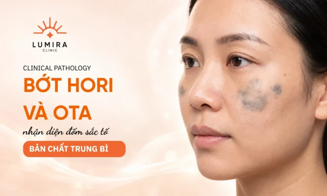 Phân biệt lâm sàng giữa bớt sắc tố Hori mắc phải và bớt Ota bẩm sinh