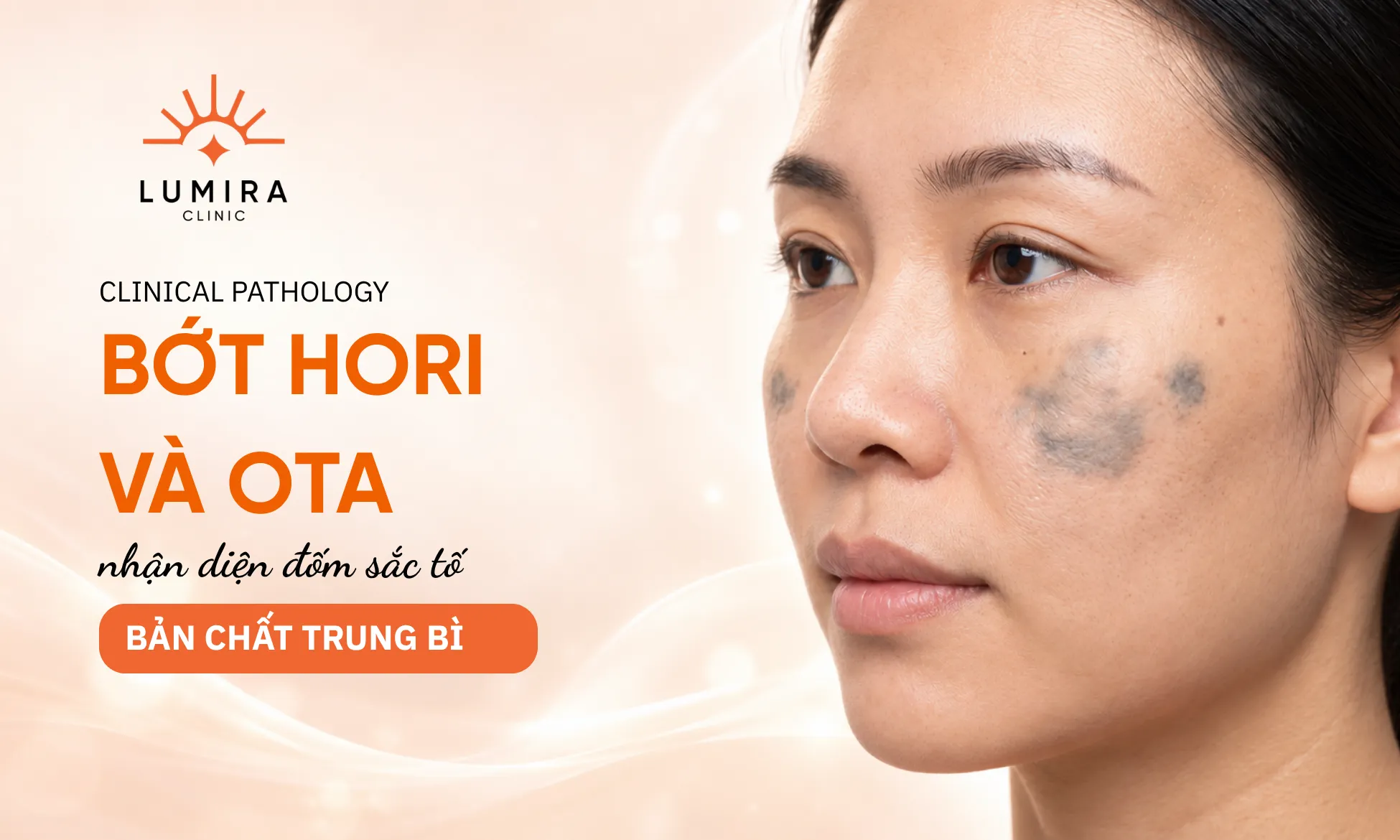 Phân biệt lâm sàng giữa bớt sắc tố Hori mắc phải và bớt Ota bẩm sinh