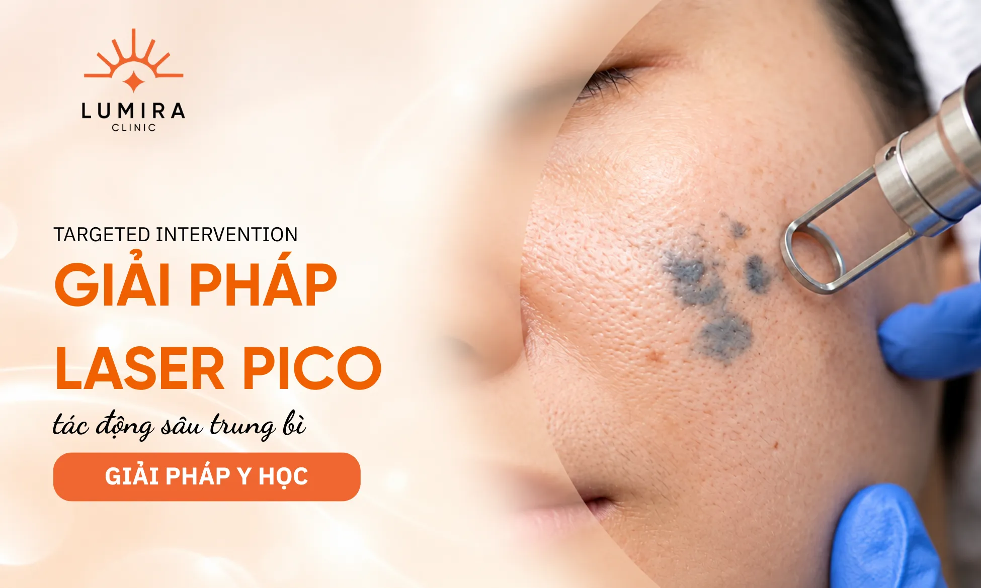 Ứng dụng công nghệ Laser Pico phá vỡ hắc tố trung bì sâu của bớt sắc tố Hori
