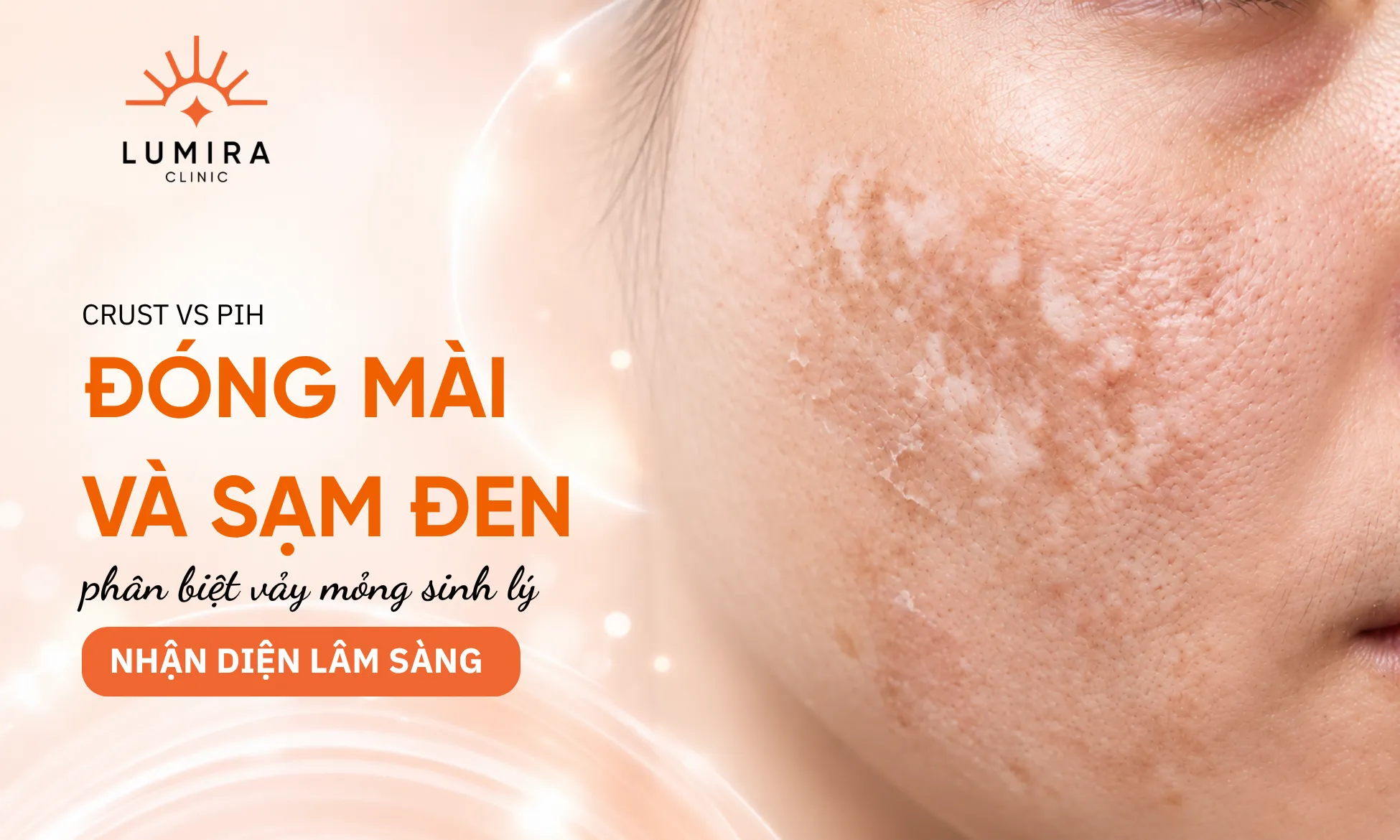 Dấu hiệu nhận biết sự khác biệt giữa lớp mài sinh lý lành tính và tình trạng sạm đen bệnh lý sau laser