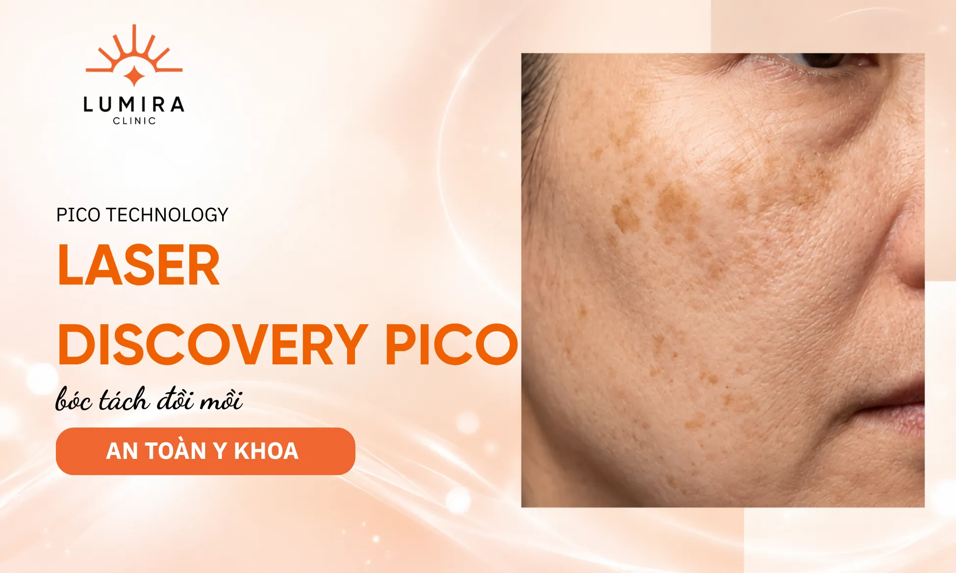 Trị liệu bóc tách đồi mồi bằng Laser Discovery Pico không để lại sẹo