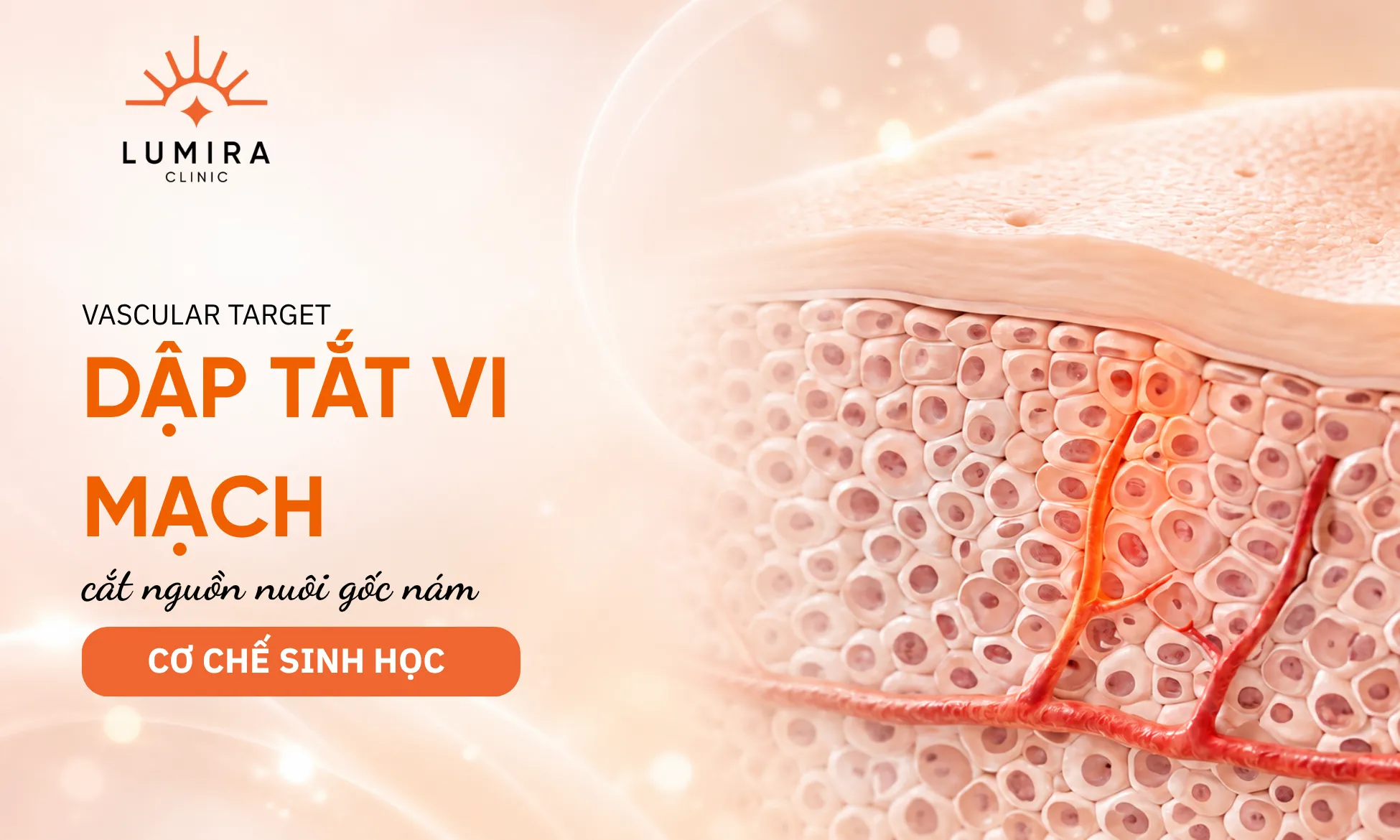 Cơ chế quang đông vi mạch máu tăng sinh nuôi dưỡng gốc nám bằng Laser Fotona xung dài