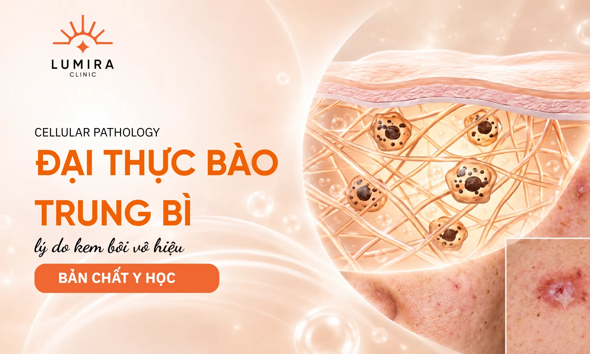 Cơ chế đại thực bào nuốt melanin nằm sâu dưới màng đáy trung bì da