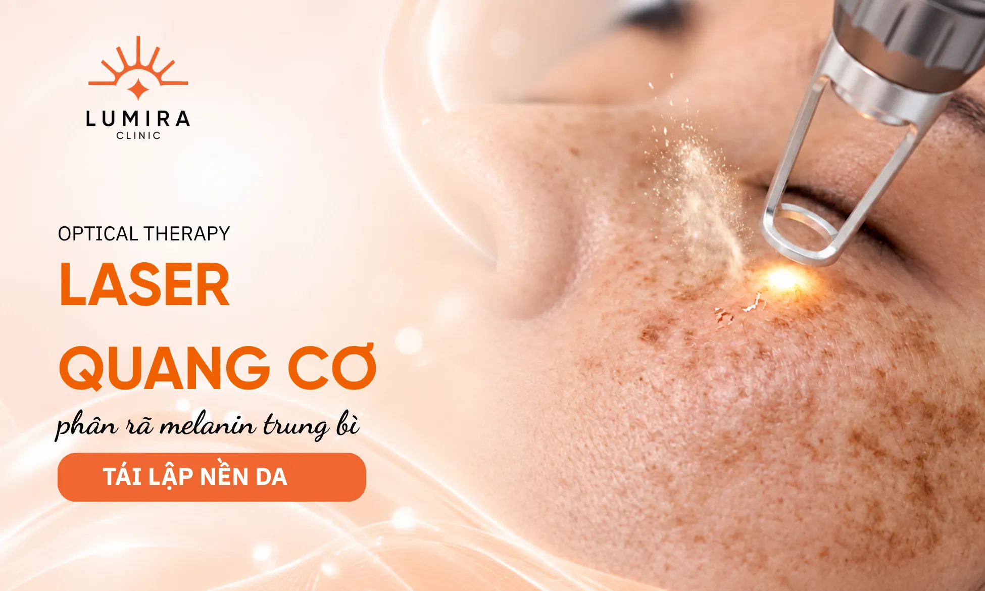 Laser quang cơ phá vỡ vi hạt melanin trung bì đào thải qua hệ bạch huyết