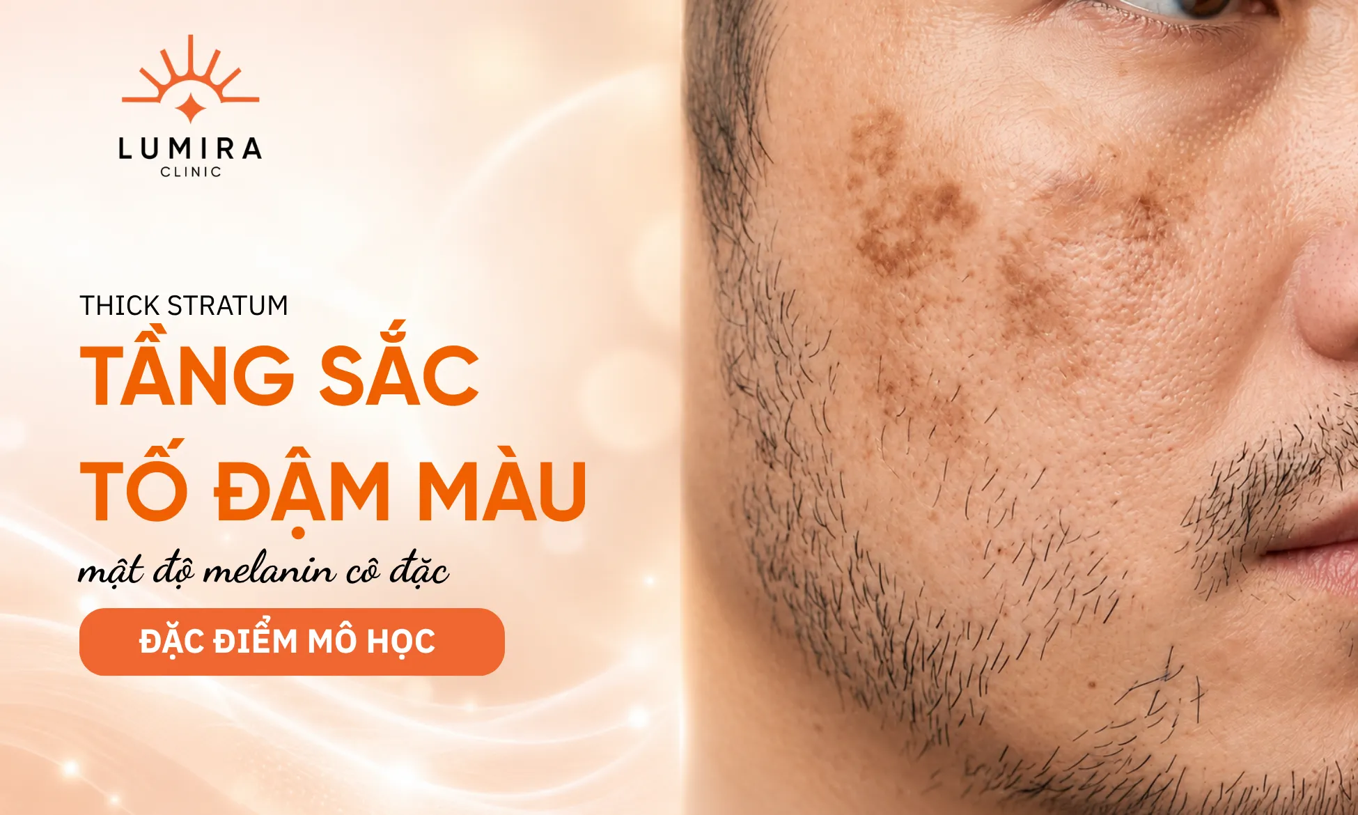 Phân tích nguyên nhân vì sao nám da ở nam giới thường đậm màu và khó điều trị hơn nữ giới
