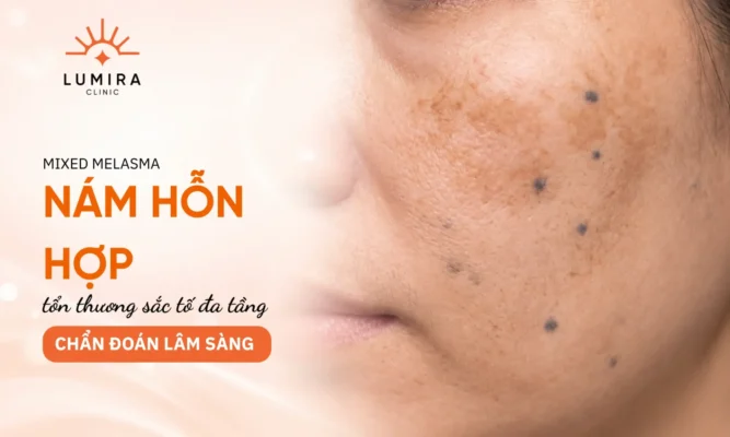 Hình ảnh lâm sàng nám hỗn hợp loang lổ với mảng nâu thượng bì và đốm xám trung bì
