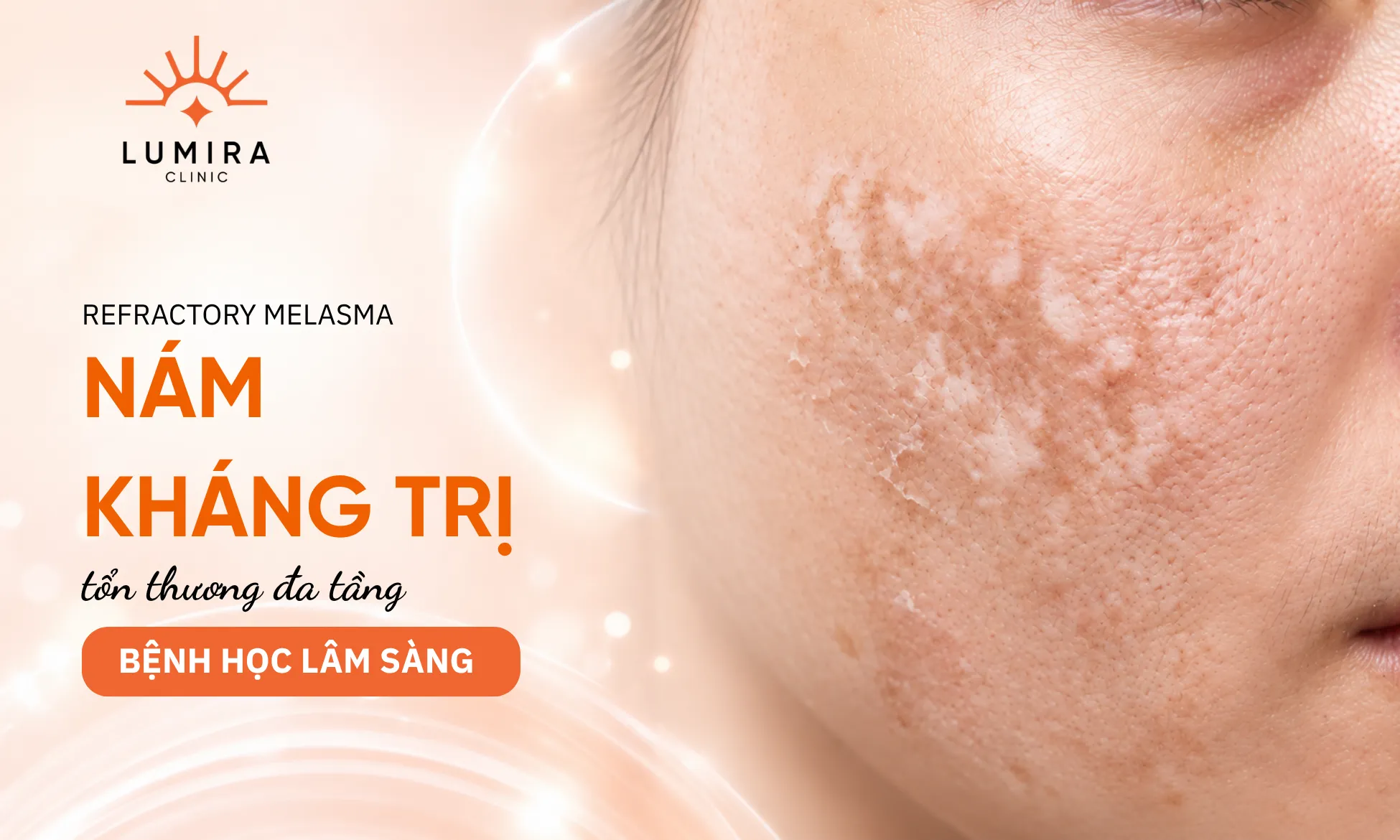 Bệnh học lâm sàng nám kháng trị với tổn thương màng đáy đứt gãy và vi tuần hoàn giãn mạch bất thường
