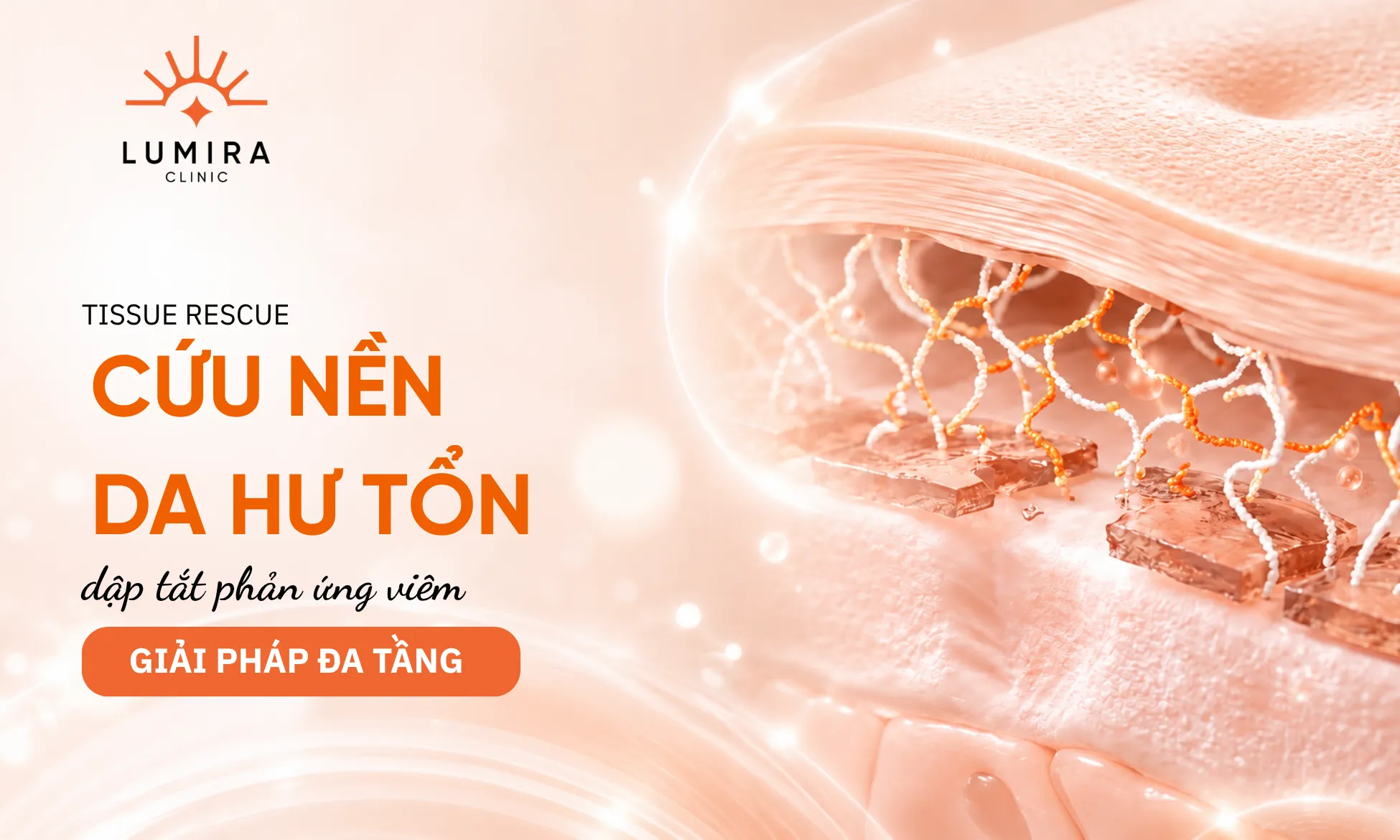 Mô hình cắt lớp cấu trúc da thể hiện sự đứt gãy màng đáy BMZ và hiện tượng melanophage thâm nhiễm trung bì