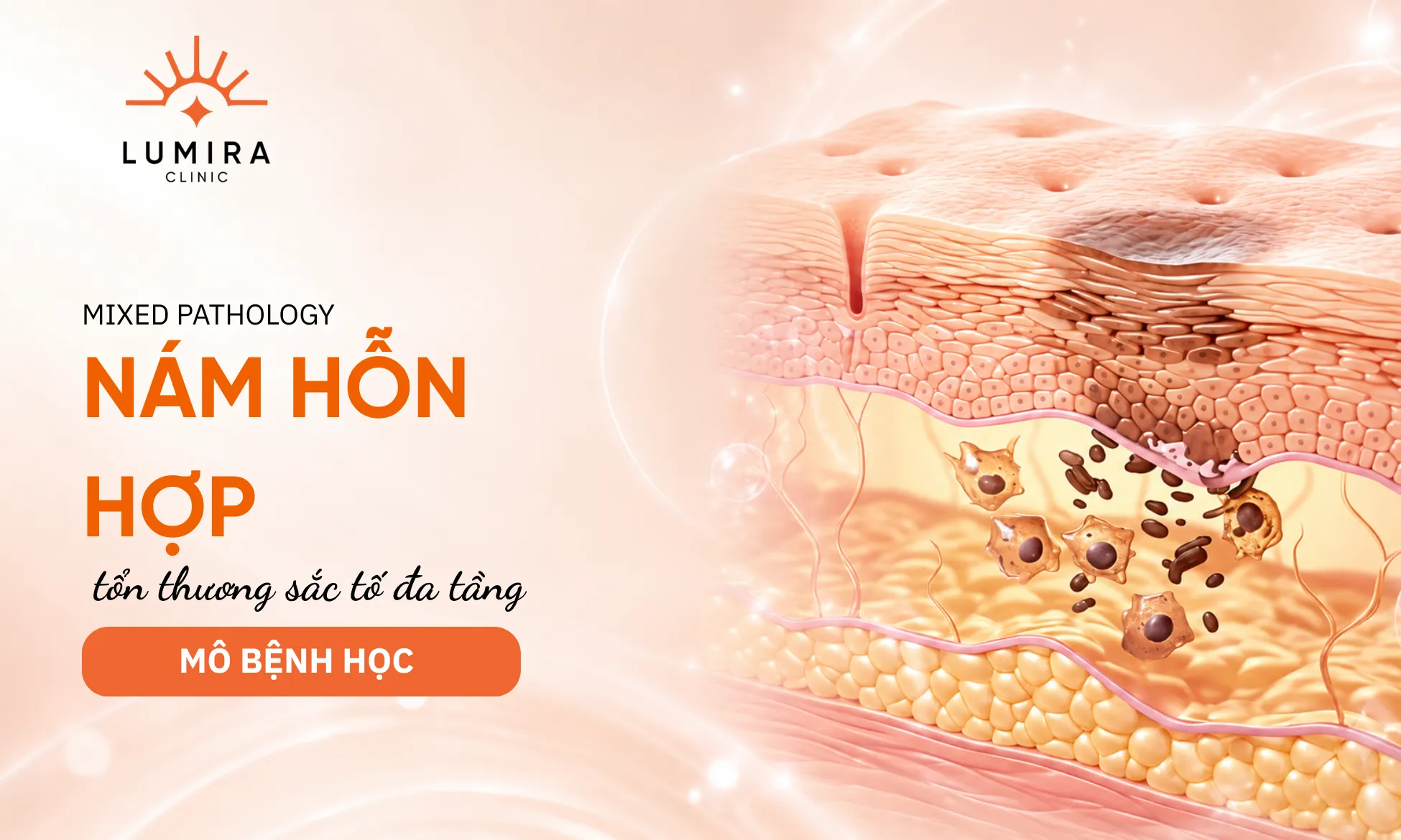 Đồ họa y khoa 3D cấu trúc da phân tầng sắc tố ở cả biểu bì và trung bì trong nám hỗn hợp
