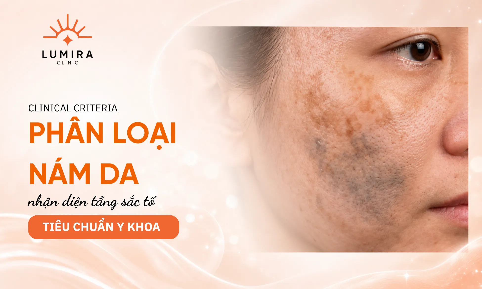 Phân loại các loại nám da lâm sàng theo tầng sắc tố nông sâu chuẩn y khoa