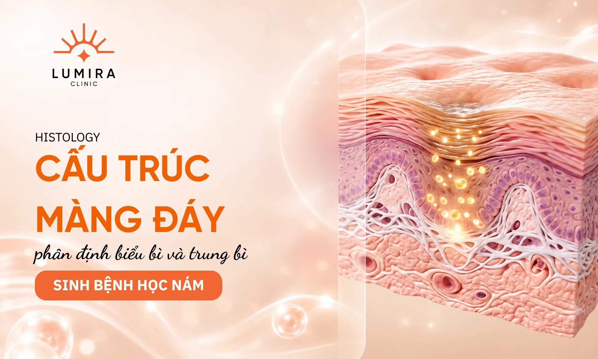 Sơ đồ cơ chế bệnh sinh của nám da: Màng đáy đứt gãy và kích hoạt tế bào sắc tố (melanocyte (tế bào sản sinh hắc sắc tố))