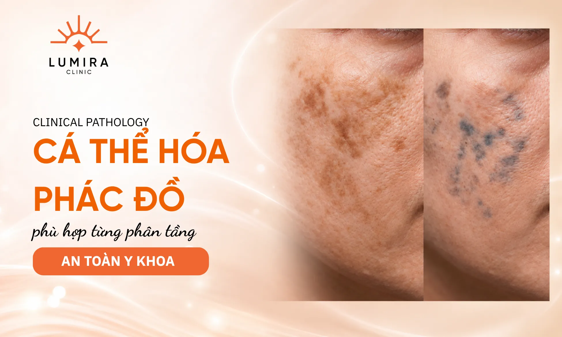 Lộ trình phác đồ cá nhân hóa theo từng phân tầng sắc tố nám da