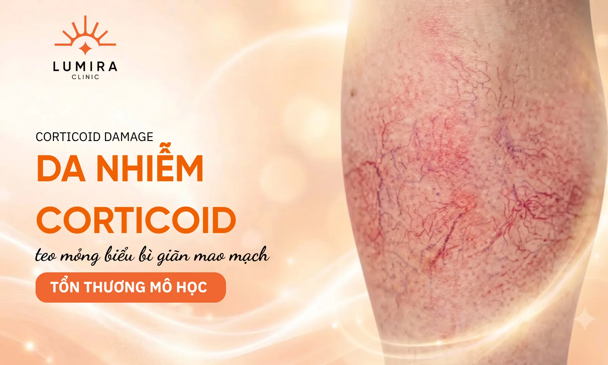 Tổn thương mô học teo mỏng biểu bì giãn mao mạch mạng nhện do lạm dụng kem chứa Corticoid