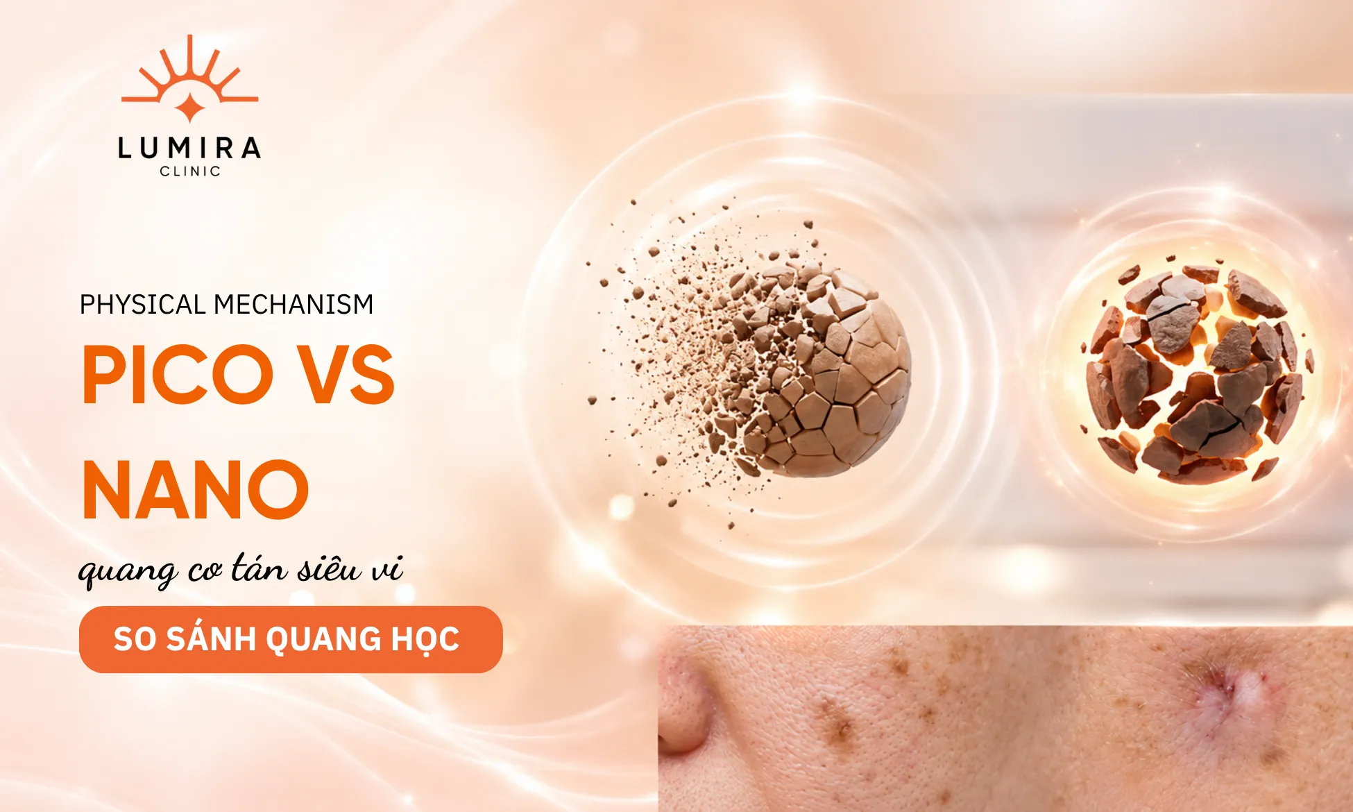 So sánh cơ chế tán vụn quang âm của Laser Pico và cơ chế tích nhiệt của Laser Nano truyền thống