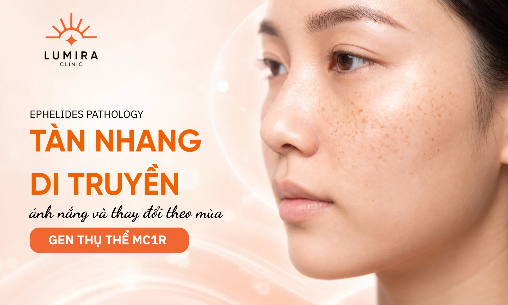 Minh họa các đốm tàn nhang nhỏ màu nâu nhạt rải rác trên gò má người trẻ