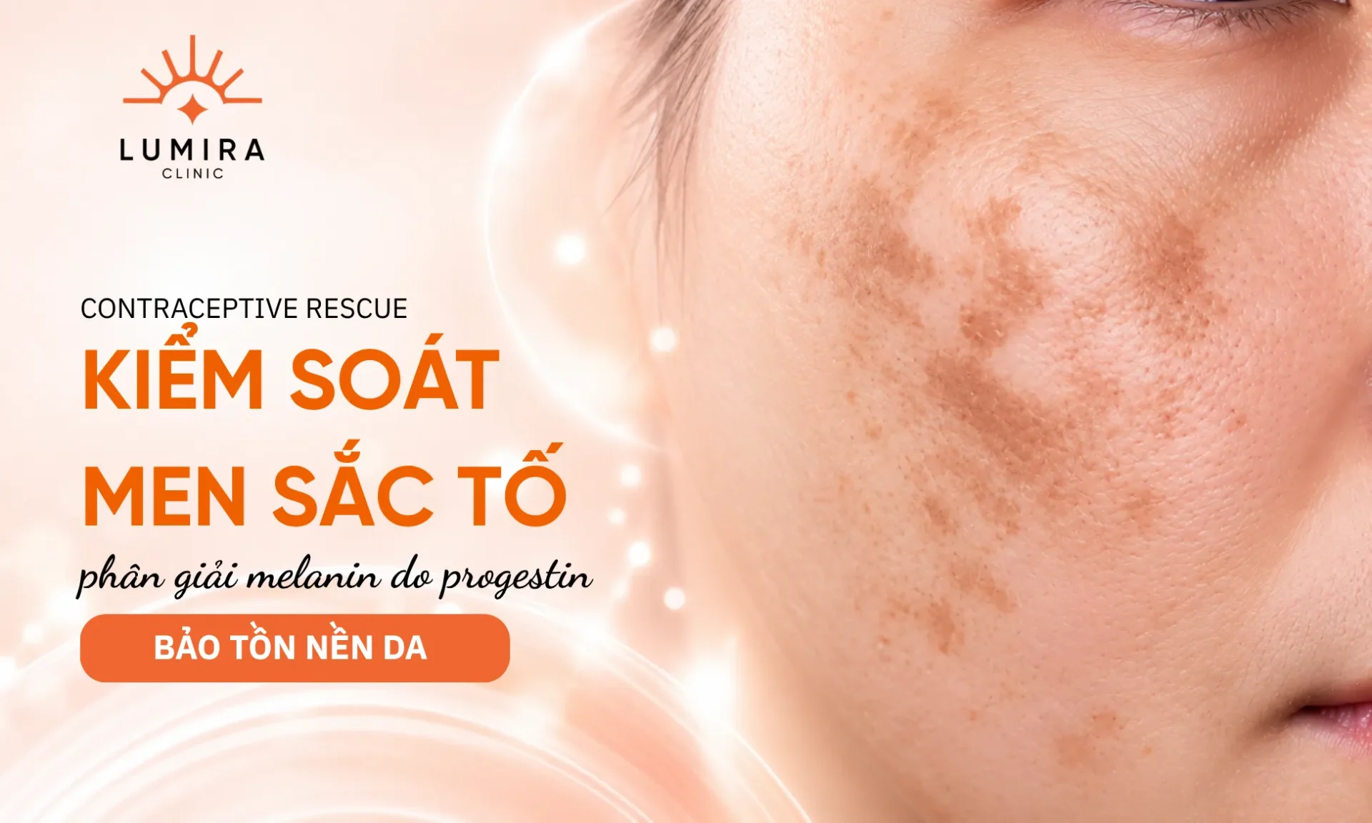Quy trình kiểm soát sắc tố nám bùng phát do thuốc tránh thai tại Lumira Clinic