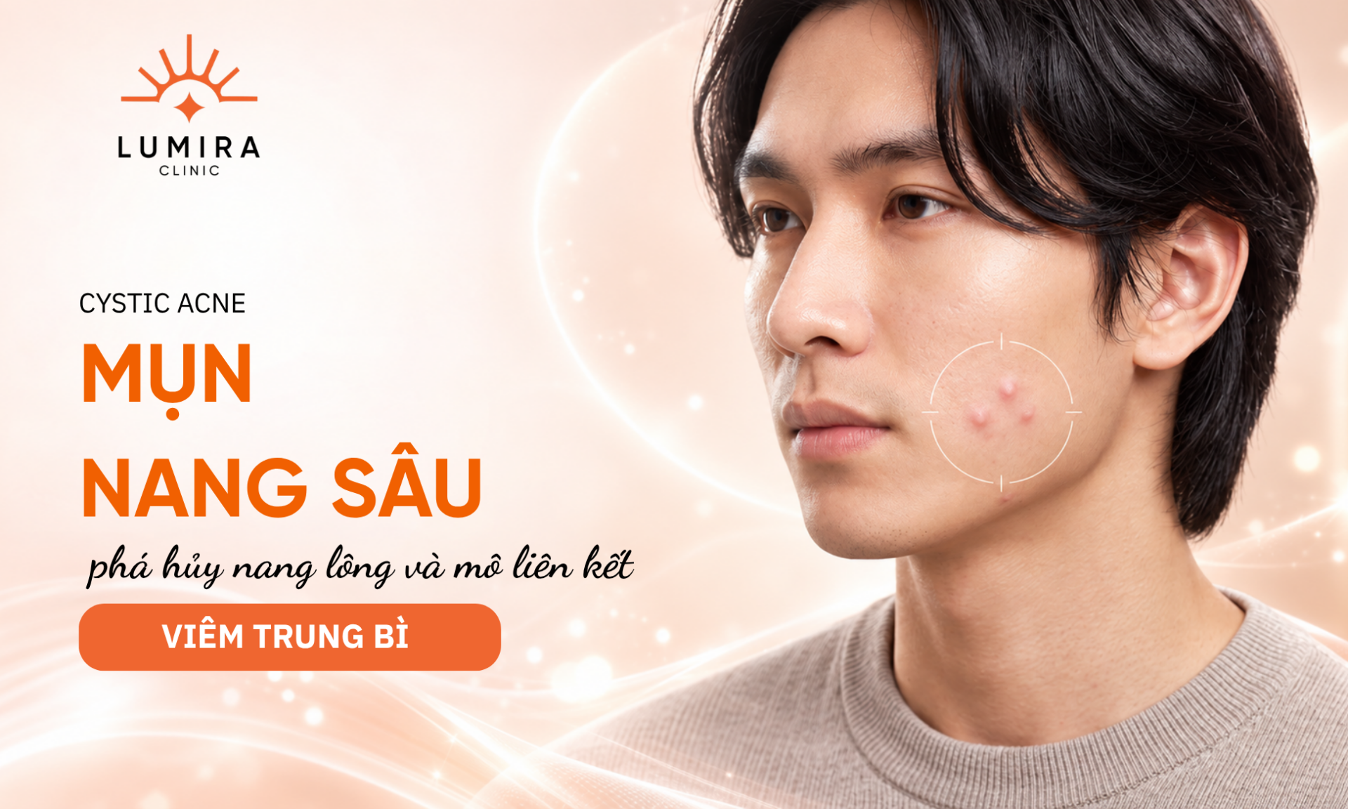 Hinh thai mun nang thuc te voi vai not go nhe mau hong an duoi da vung ma - Lumira Clinic