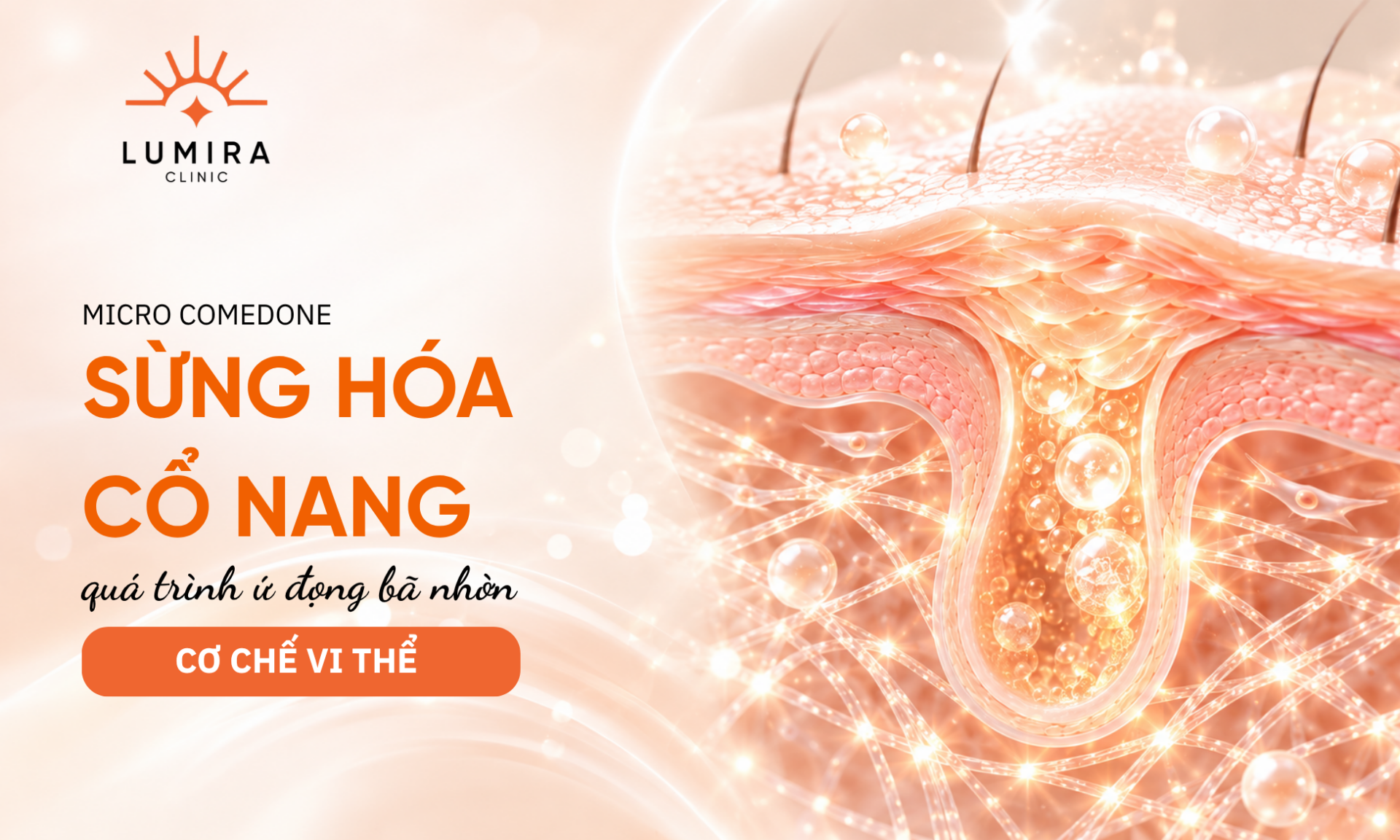 Co che vi the sung hoa co nang long va su hinh thanh vi nhan mun - Lumira Clinic